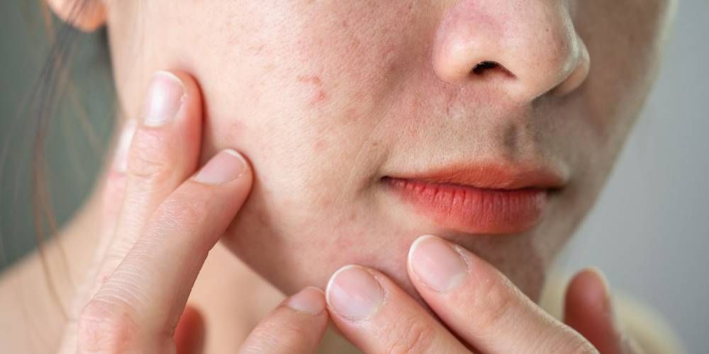 Skin Repair Treatment