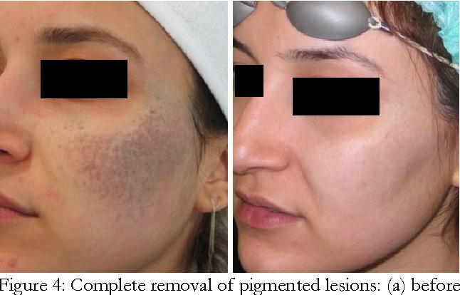 How many sessions of laser treatment needed to remove birthmark?