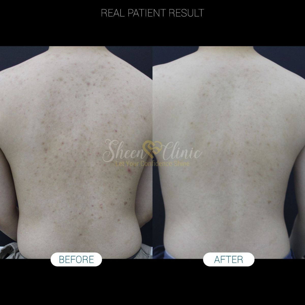 The International Student��s Guide to Treating Sudden Back Acne (Bacne) in Malaysia