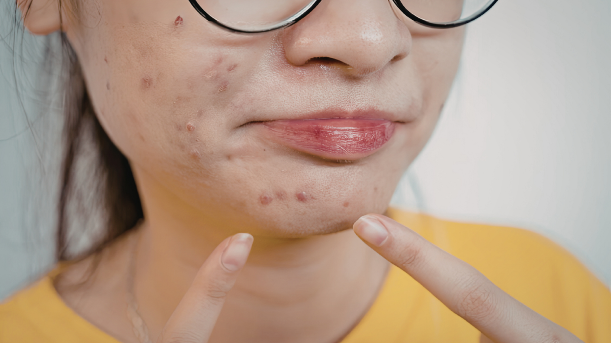 Eating Your Way to Acne-Free Skin | Diet Tips for Clear Skin