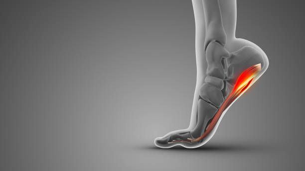 The First Step Shock: How Hard Flooring Exacerbates Morning Plantar Fasciitis Pain