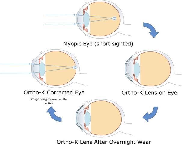Adult Vision Correction: Ortho-K vs Refractive Surgery ����������������OK�������������ľ���