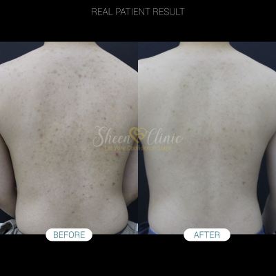 The International Student��s Guide to Treating Sudden Back Acne (Bacne) in Malaysia