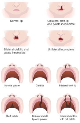 Understanding Cleft Lip and Cleft Palate: A Comprehensive Guide