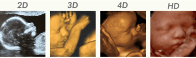 What is the different between 2D 3D 4D and 5D ultrasound for pregnancy?