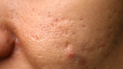 Best Acne Scar Treatments in Klang Valley | Zenth Pore Specialist