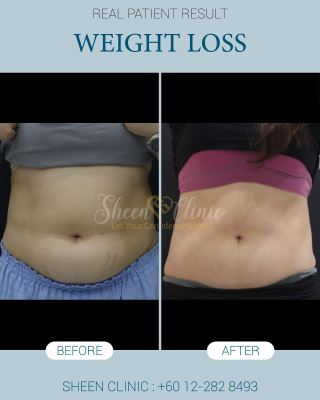 Tummy fat loss in subang jaya