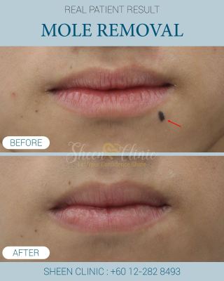 Mole Removal in shah alam