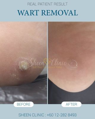 Foot Wart Removal in Subang Jaya