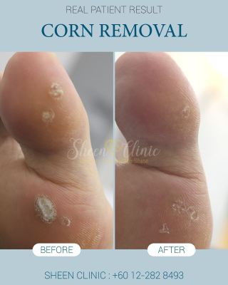 foot Corn Removal subang jaya