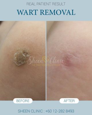 Wart Removal Sheen Clinic.jpg