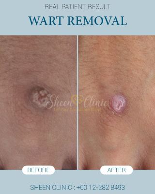 Wart Removal hand petaling jaya.jpg