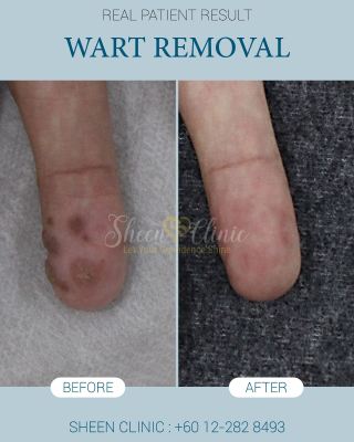 Wart Removal finger sheen clinic - Consented.jpg