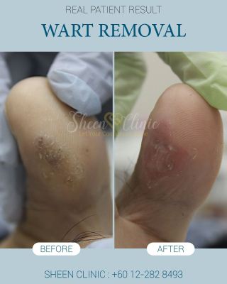 Wart at toe - Consented.jpg
