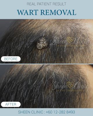 Wart at scalp subang jaya.jpg