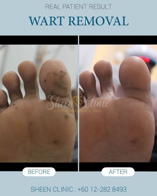 wart at foot subang jaya.jpg