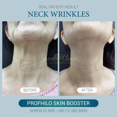 Neck line treatment in Subang jaya