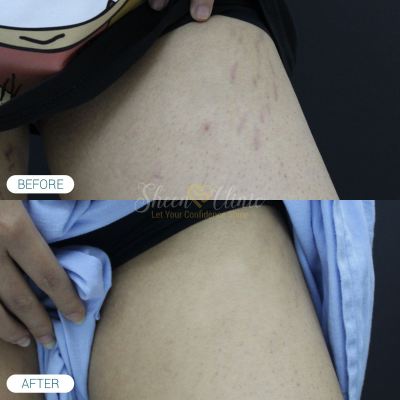 Before & After Stretch Mark Treatment in Subang Jaya