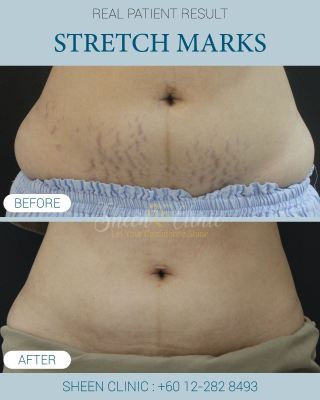 Post delivery stretch mark treatment KL