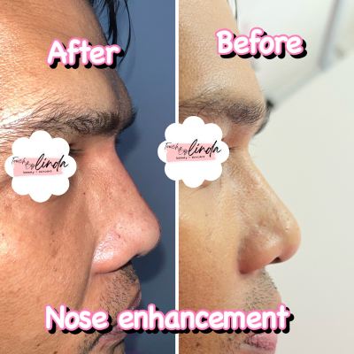 Nose Enhancement (Filler) For Ampang Client