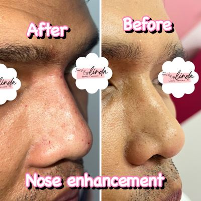 Nose Enhancement (Filler) For Ampang Client