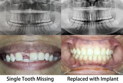 Single Case �C Replace Single Missing Tooth with a Tooth Implant.jpg