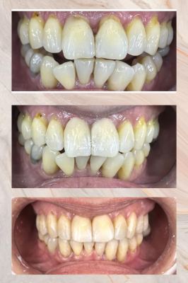 Before & After various treatments