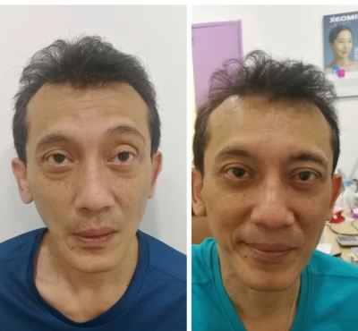 Eyebag Removal before after