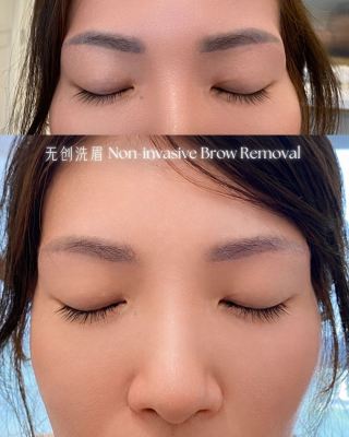 Laser Removal