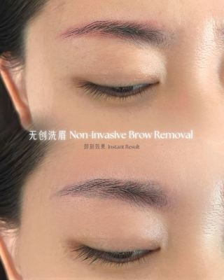 Laser Removal