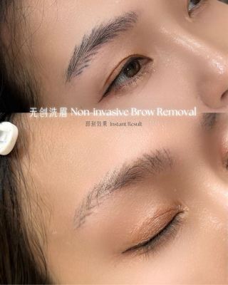 Laser Removal