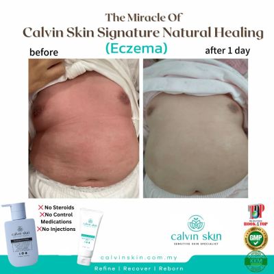 BABY ECZEMA CASE FEEDBACK