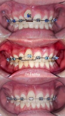 BRACES BY ORTHODONTIST, DR FATHY 