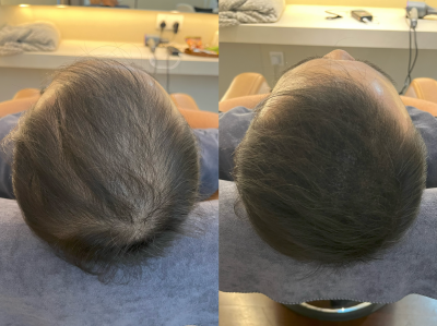 Hair Growth Activation Treatment