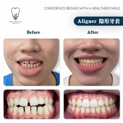 Aligner ��������