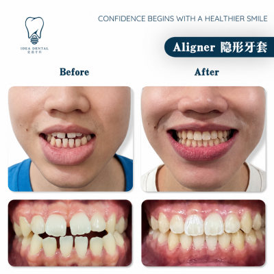 Aligner ��������
