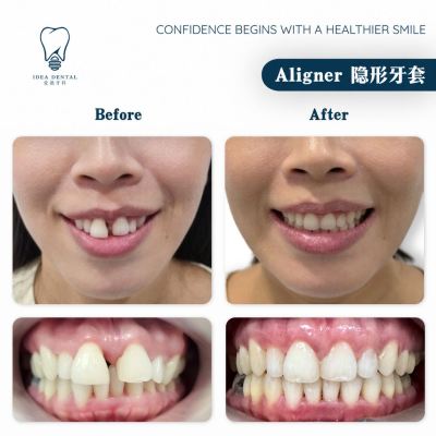 Aligner ��������