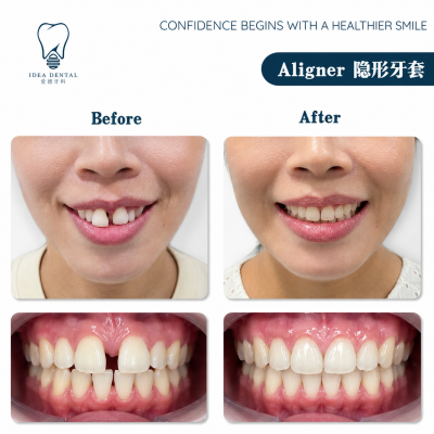 Aligner ��������