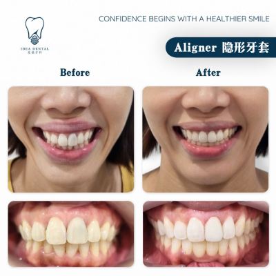 Aligner ��������