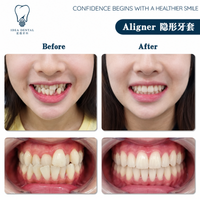 Aligner ��������