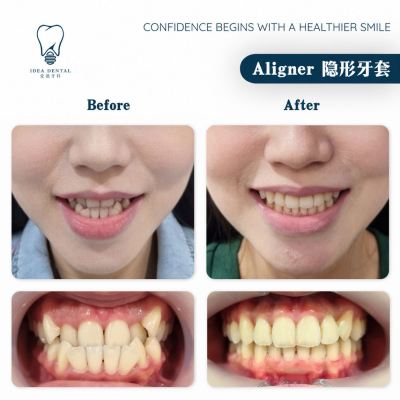 Aligner ��������