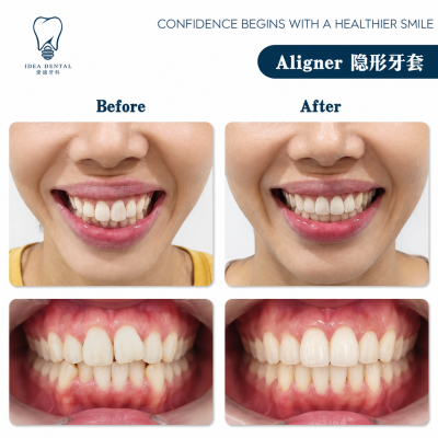 Aligner ��������