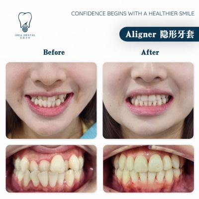 Aligner ��������