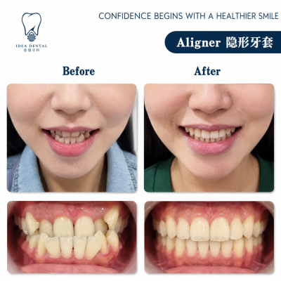 Aligner ��������
