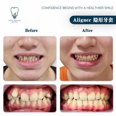 Aligner ��������