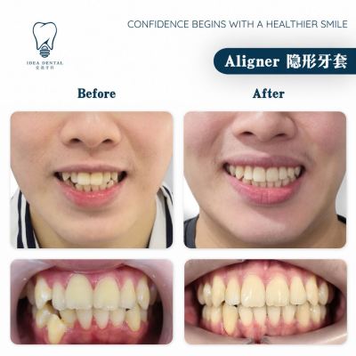Aligner ��������