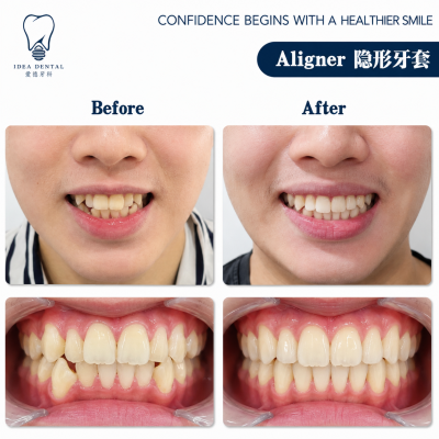 Aligner ��������