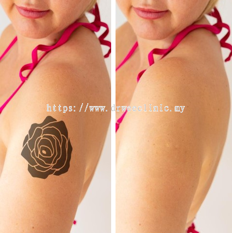 Laser Tattoo Removal for Tattoo Modification – UNBRANDED Austin Tattoo  Removal