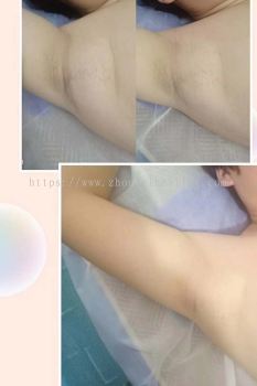  Toning Supernumerary Breasts