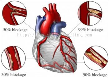 血管疾病冠心病